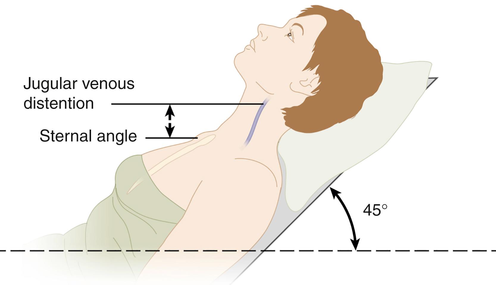 FIG. 16.6, Distention of the internal jugular vein.