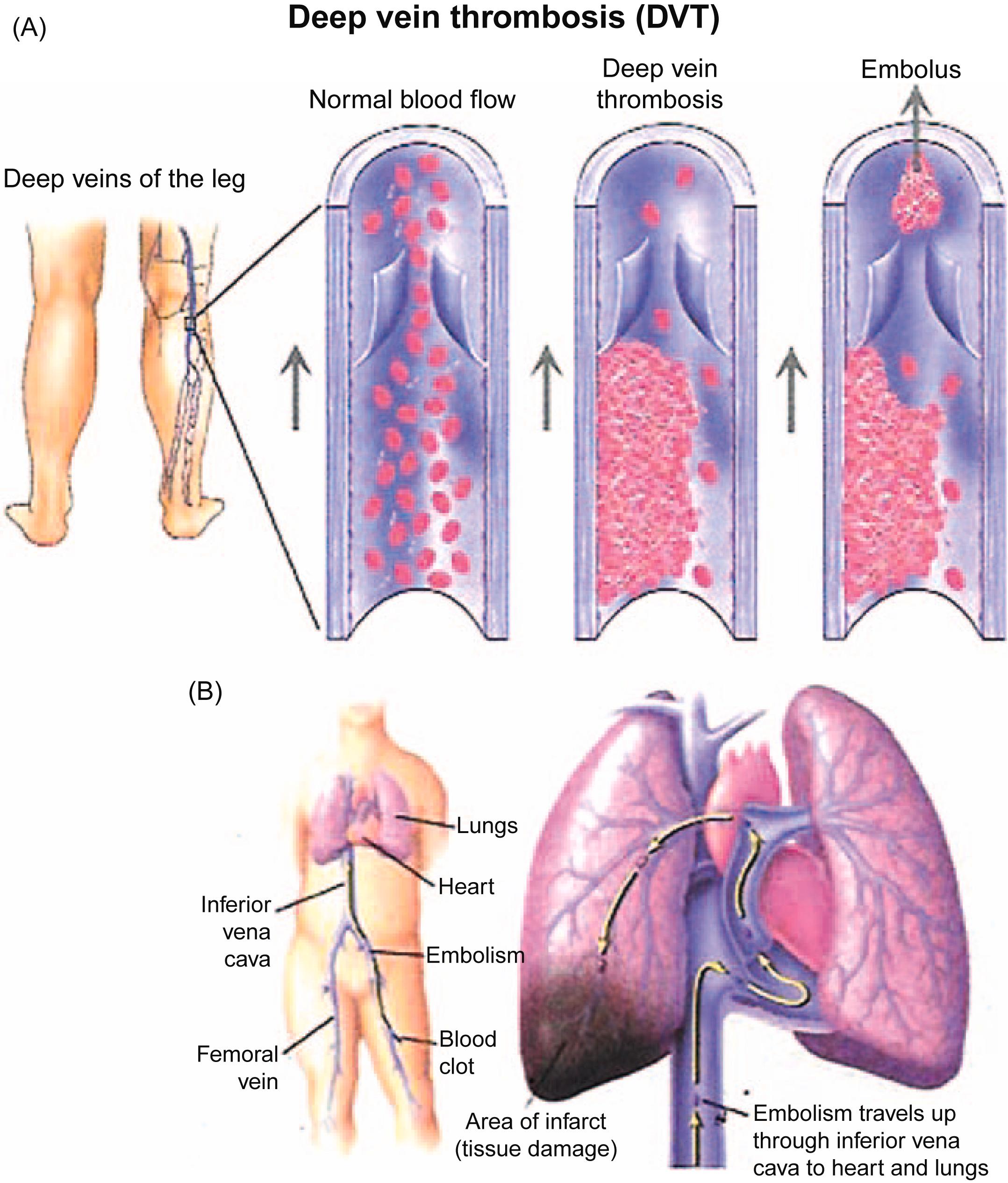 Figure 21.2, (A) Deep vein thrombus in the leg. (B) Site of pulmonary embolus.