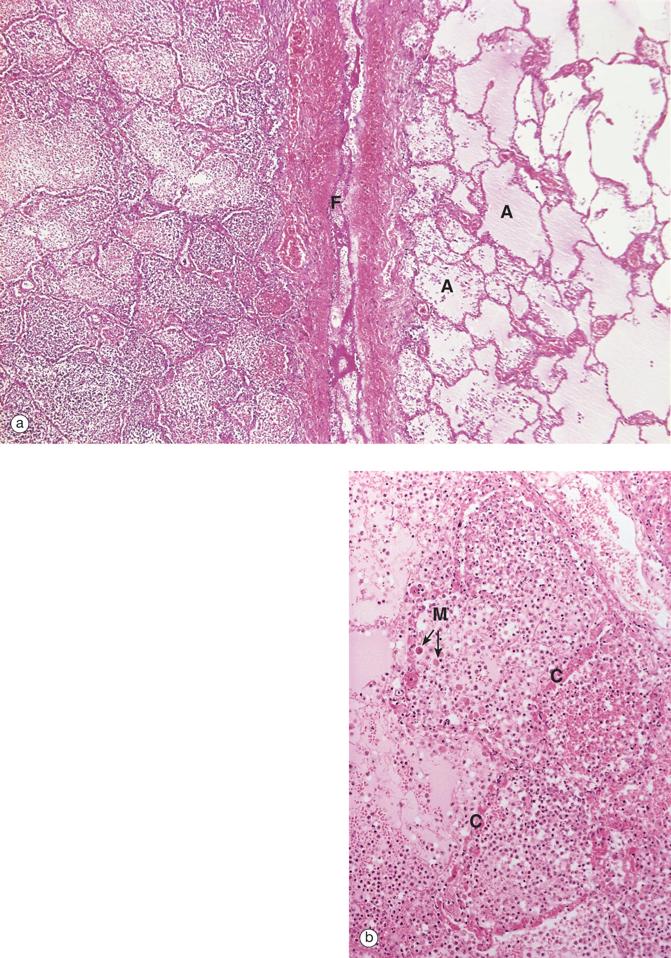E-Fig. 3.2, Established acute inflammation: lobar pneumonia