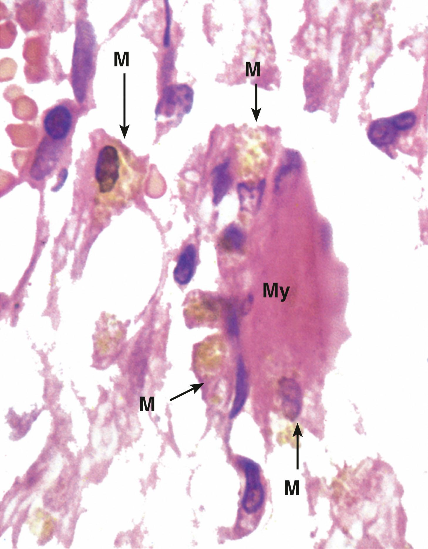 E-Fig. 3.3, Early outcome of acute inflammation: macrophage accumulation (HP)