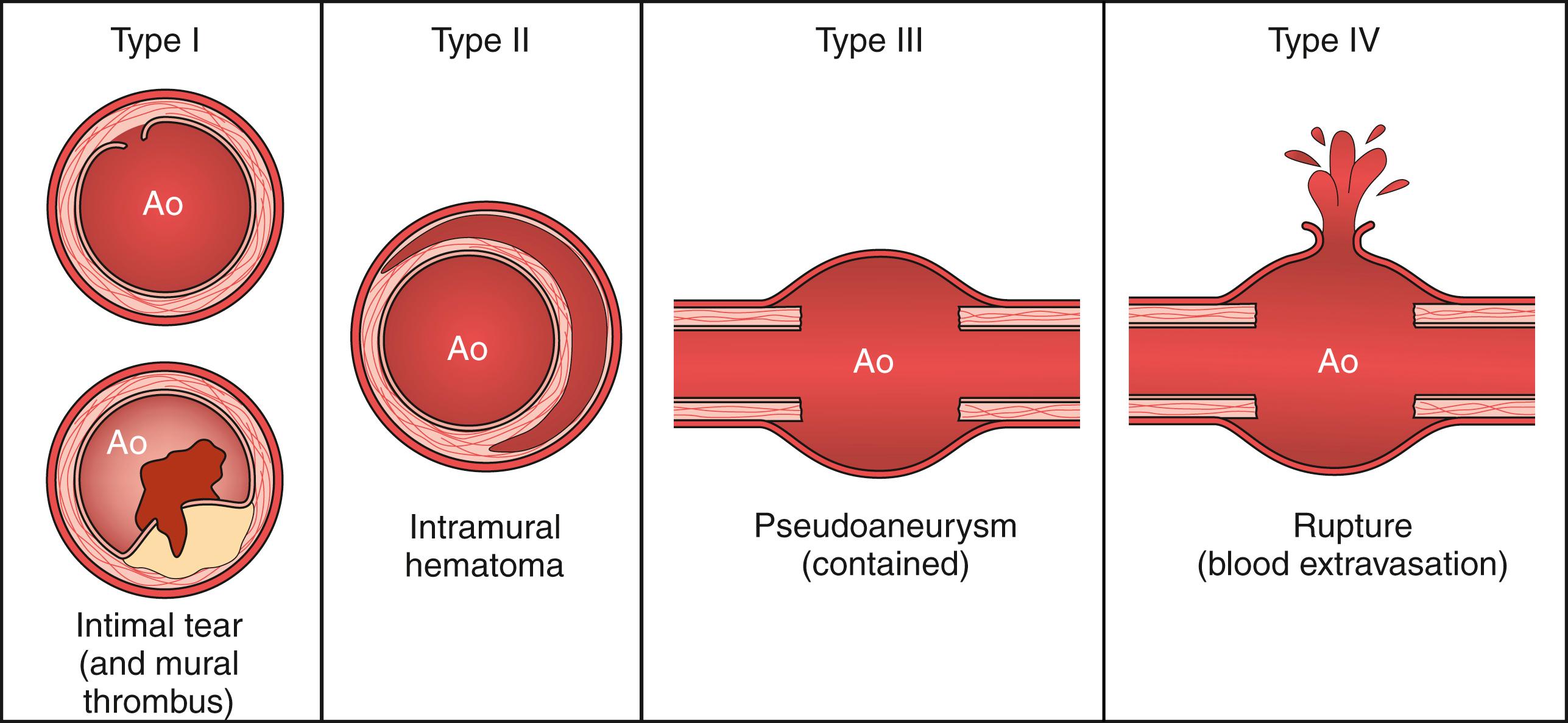 Figure 135.1, Schematic representation of proposed classification for blunt aortic trauma. Type I injuries may be managed conservatively because they usually heal spontaneously, whereas other types require correction (see text for details). Ao, Aorta.