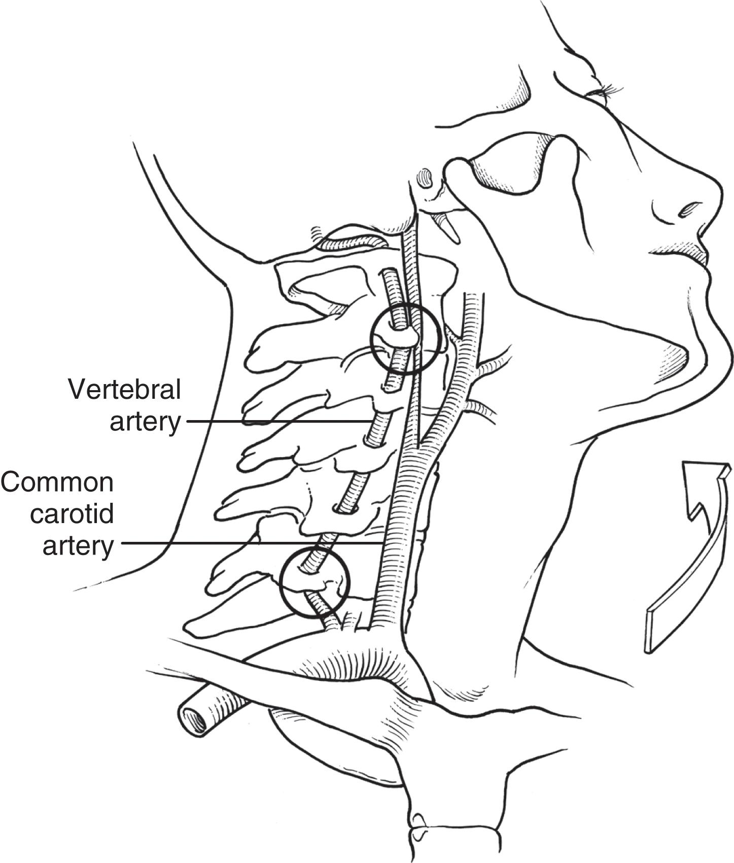 FIGURE 1, Cervical rotation and hyperextension result in a stretch injury of the carotid and vertebral vasculature.