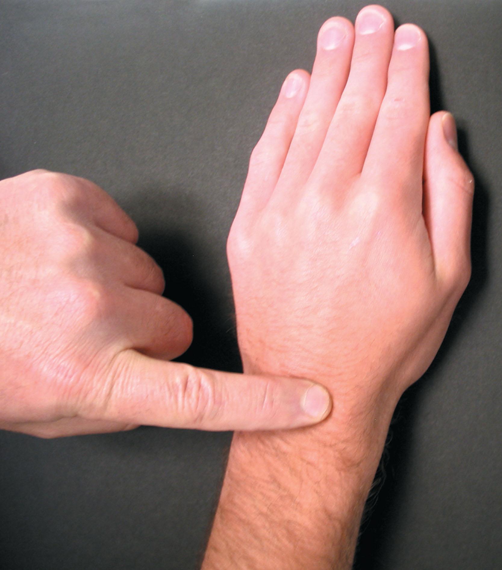 Fig. 9.2, The hunchback sign for carpal boss.