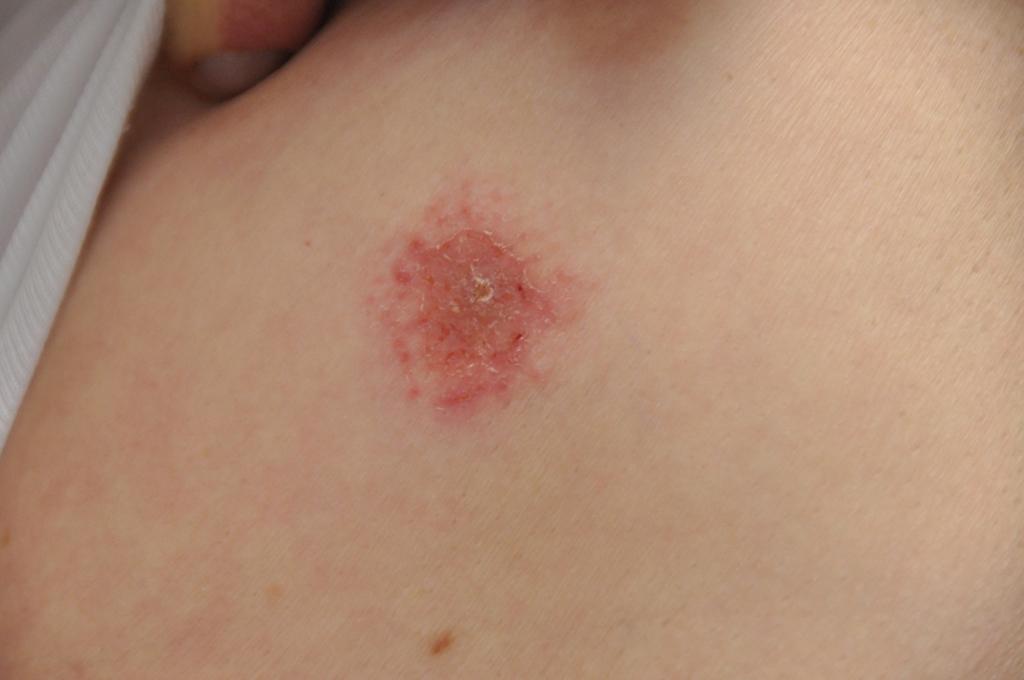 Fig. 3.4, Nummular dermatitis.