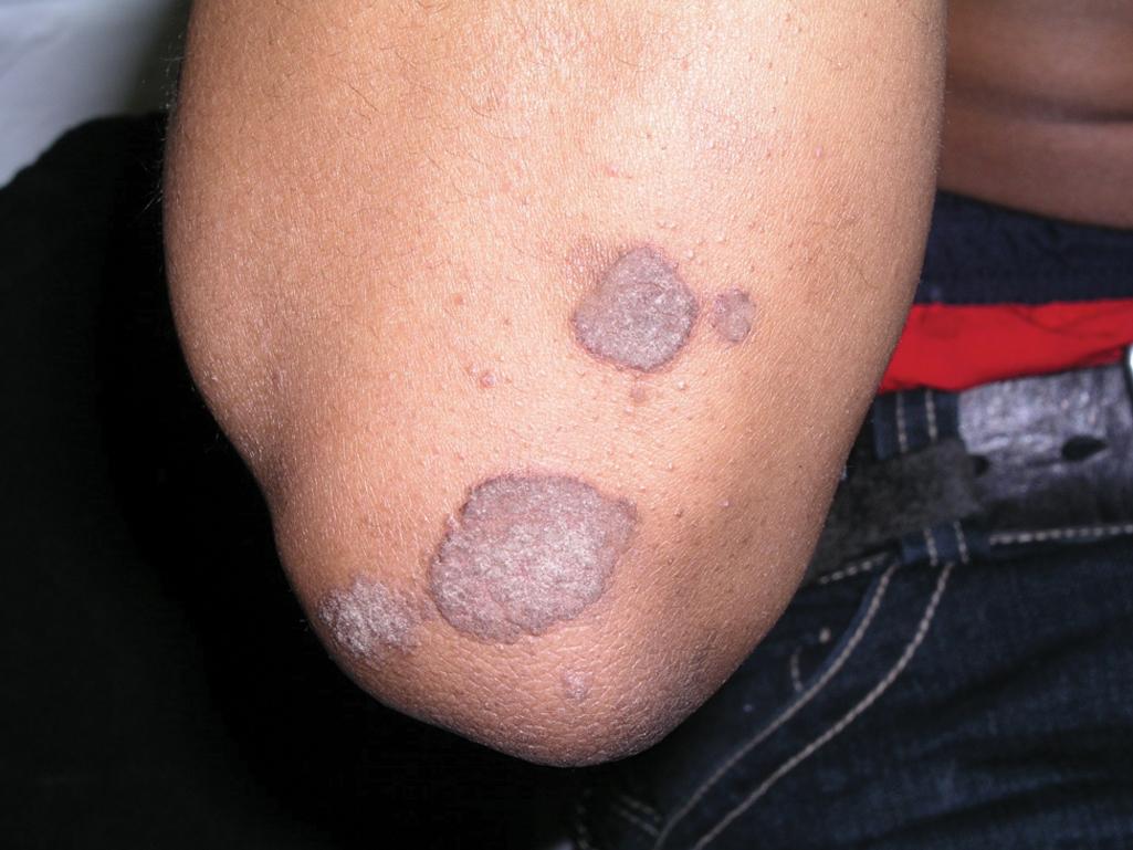 Fig. 3.5, Plaque Psoriasis.