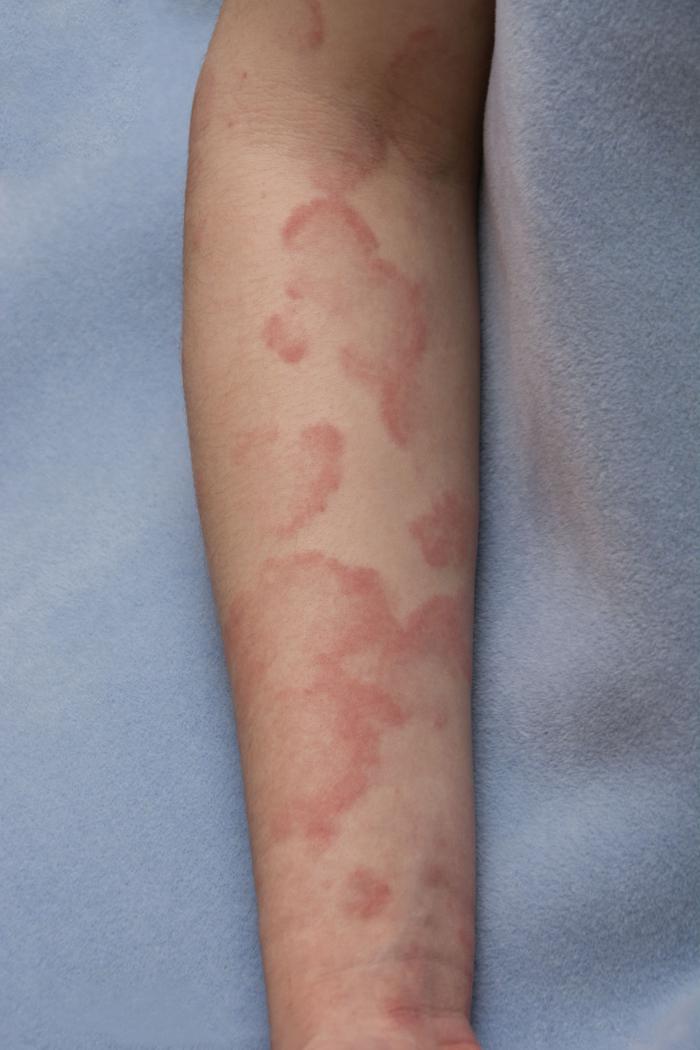 Fig. 3.6, Urticaria.