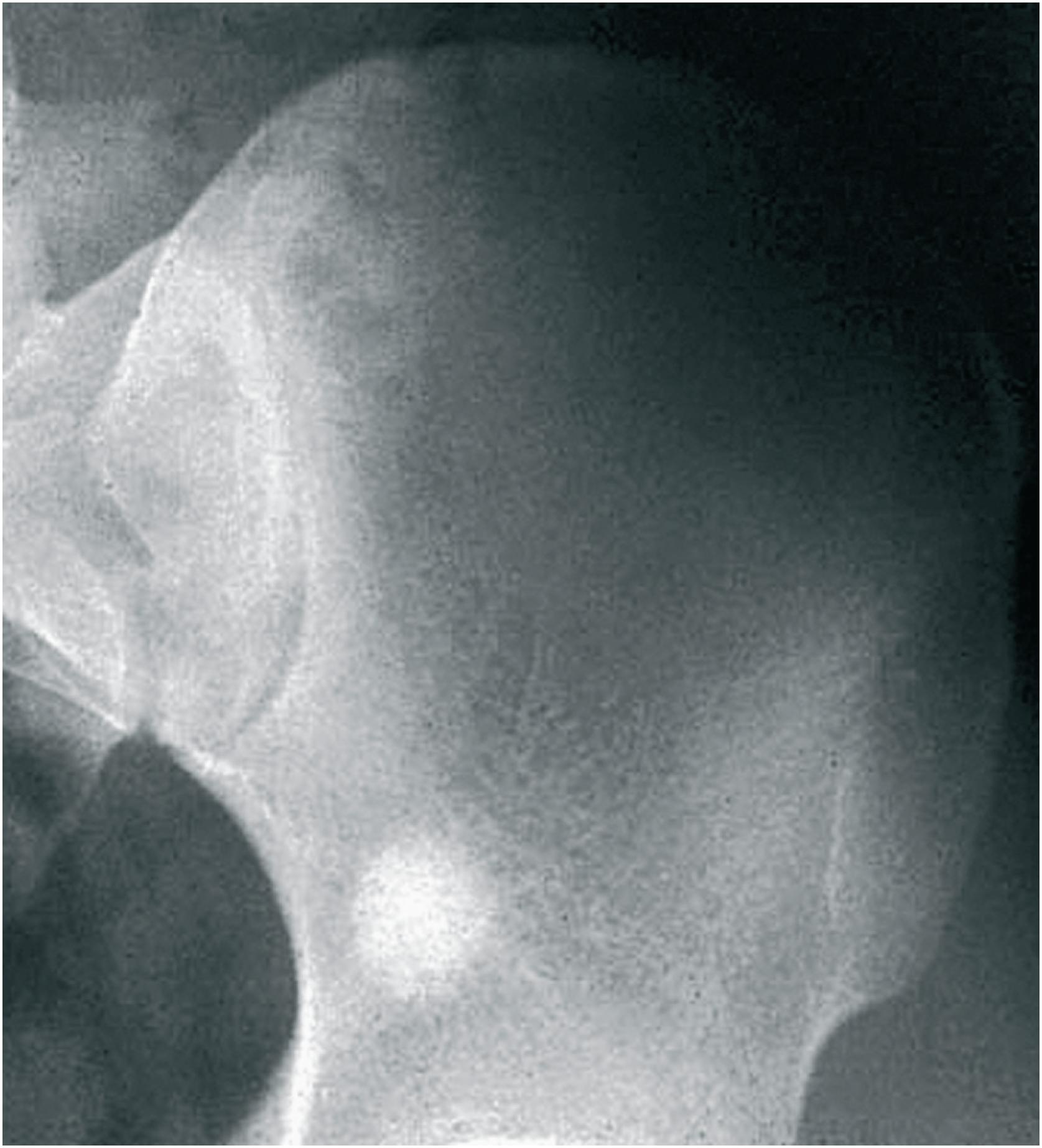 Fig. 16.1, Bone island involving the wing of the sacrum. The lesion is small, round, and radiodense.