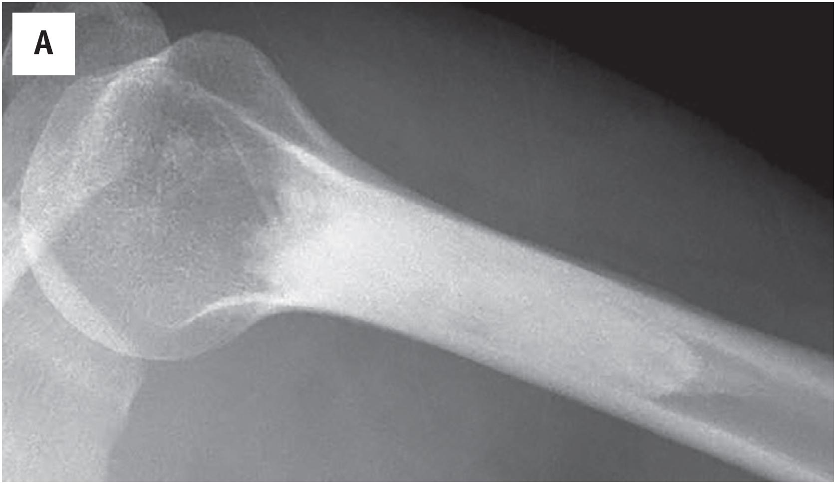 Fig. 16.2, (A) The large bone island is radiodense and fills medullary cavity of humerus in this lateral radiograph. (B) Axial computed tomographic scan of a large bone island replacing the medullary cavity.