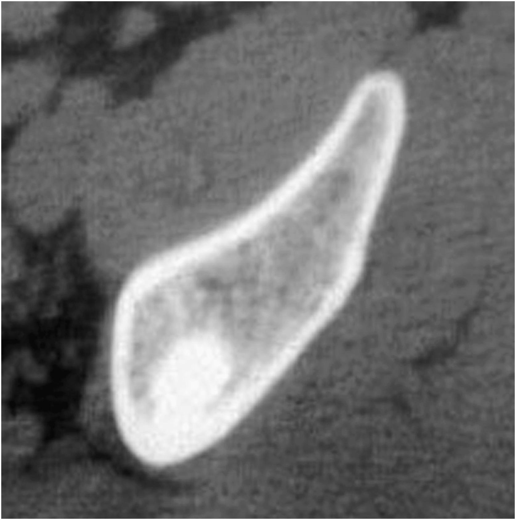 Fig. 16.3, Axial computed tomographic scan of a bone island in the ilium. Note the speiulated margin and homogeneous radiodensity.