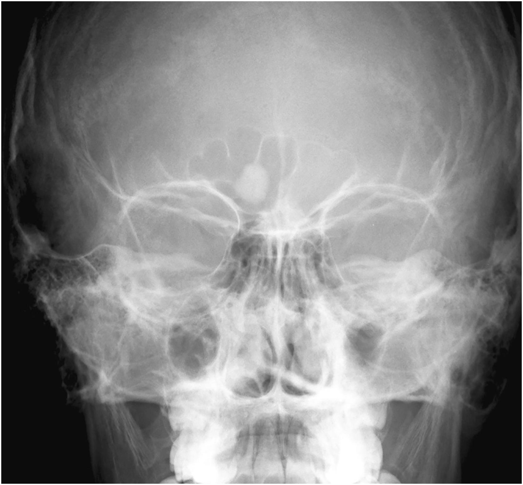 Fig. 16.6, Frontal radiograph of osteoma that is round and radiodense arising in the frontal sinus.