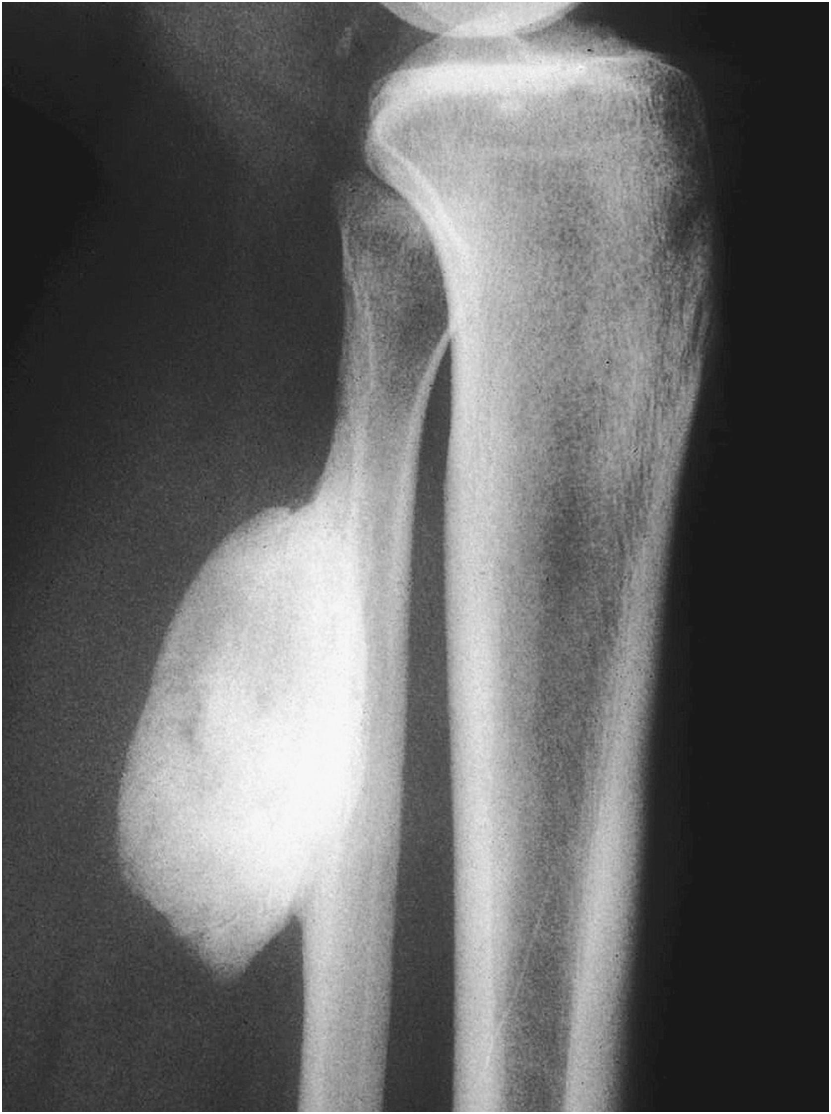 Fig. 16.7, Osteoma arising on the surface of the fibula. The tumor is ovoid, well circumscribed, and radiodense.