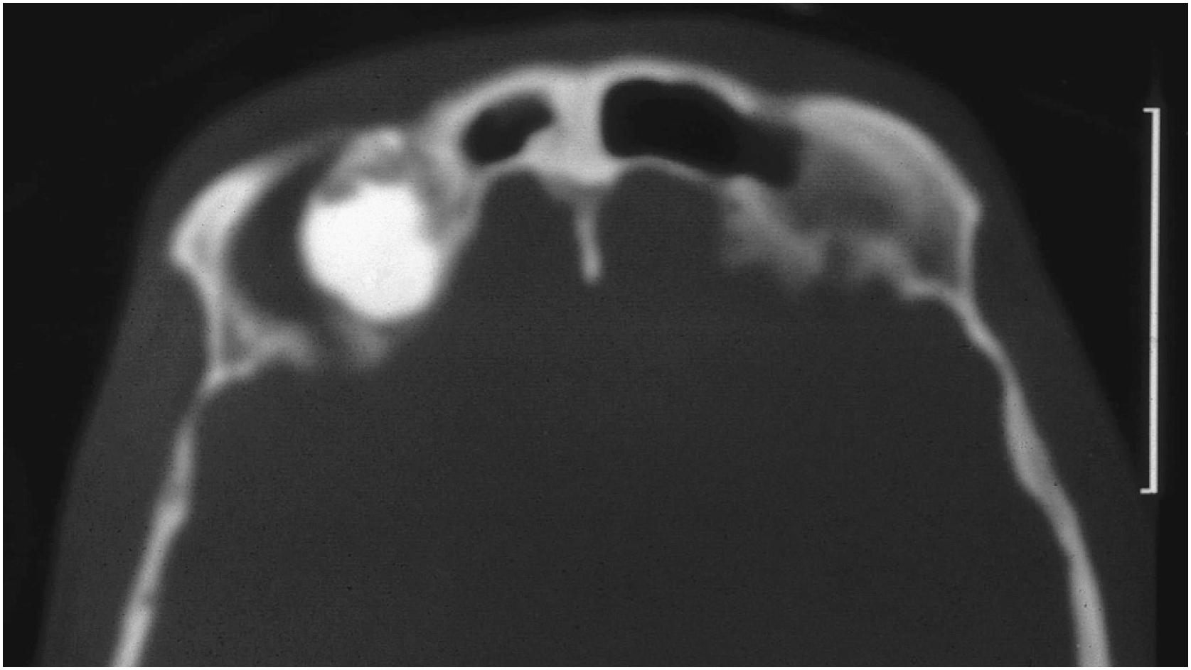 Fig. 16.8, Axial computed tomography of osteoma involving frontal sinus.