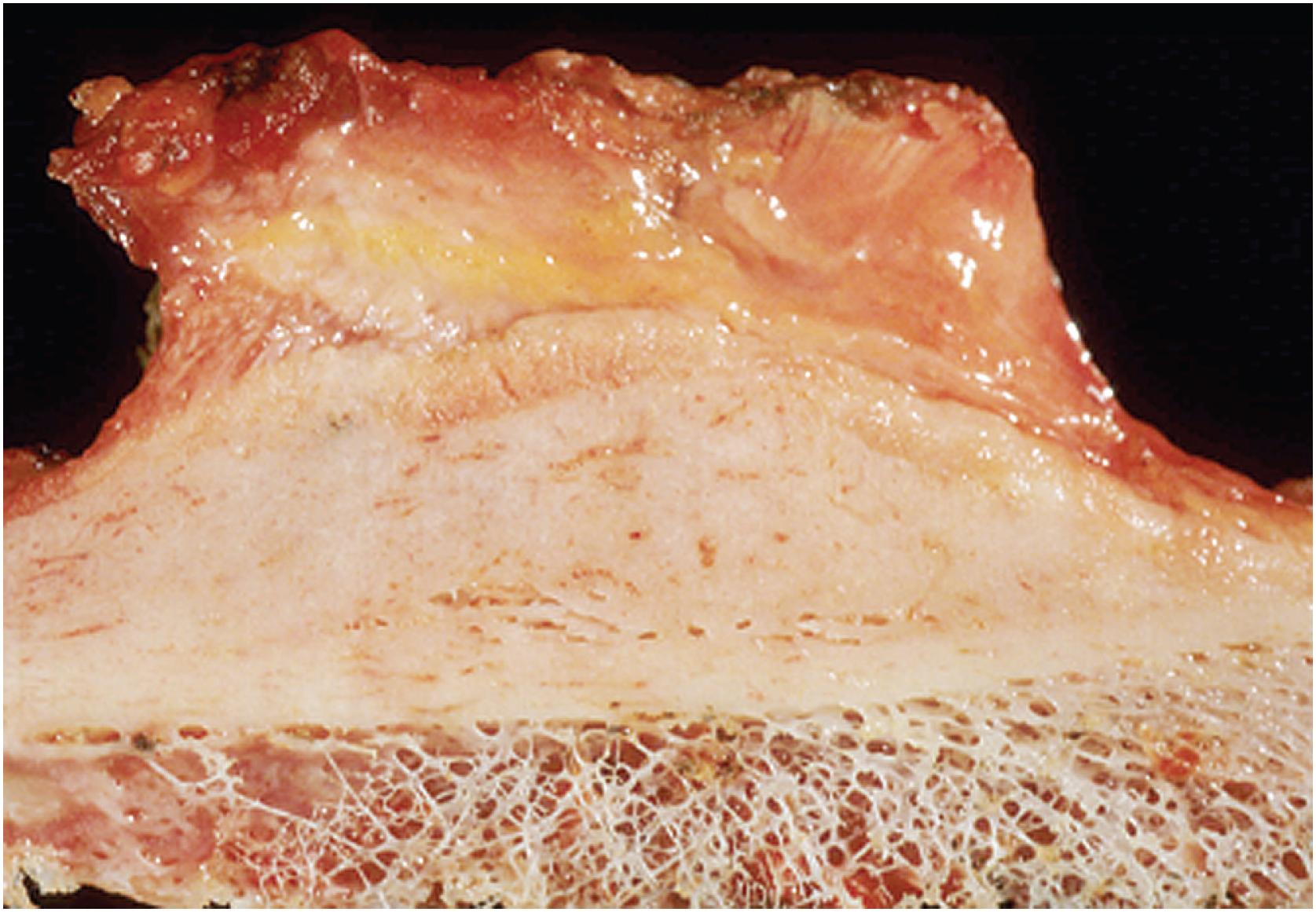 Fig. 16.10, Gross image of osteoma of long bone. The tumor is dense, tan-white, and merges with the underlying cortex.