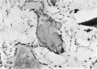 FIGURE 22A.4, Photograph of a histologic section from a 3-week postoperative biopsy specimen. Granules of demineralized bone (B) are visible and are surrounded by plump osteoblasts (O) and new osteoid. Vascular stroma is present throughout the allografted area. No histologic evidence of bone resorption is seen (hematoxylin-eosin stain; original magnification ×160).