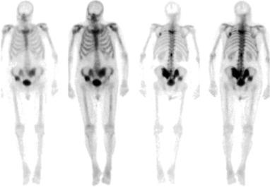 Figure 53.4, A staging bone scintigraphy on a 77-year-old male patient with prostate cancer.