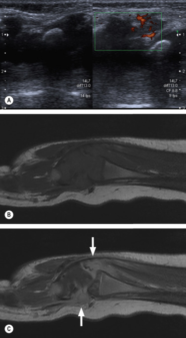 Fig. 46.1, Septic Arthritis in a Child.