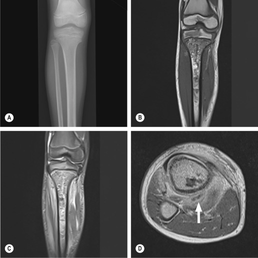 Fig. 46.2, Osteomyelitis of the Tibia With Abscess Formation.