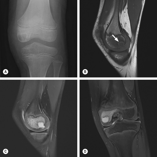 Fig. 46.3, Osteomyelitis With Epiphyseal Abscess Formation in a Child.