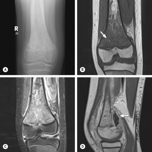 Fig. 46.4, Osteomyelitis of the Distal Femur in a Child.