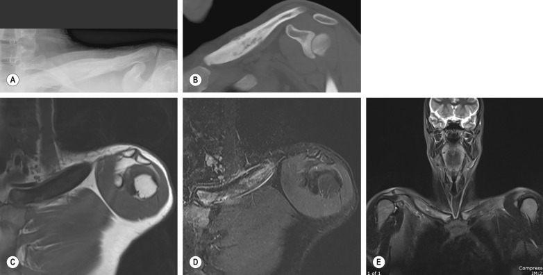 Fig. 46.5, Chronic Recurrent Multifocal Osteomyelitis of the Left Clavicle.