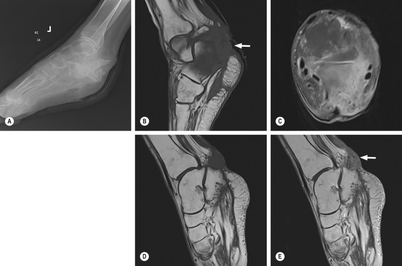 Fig. 46.6, Malignant Transformation in a Chronic Ulcer Related to Chronic Osteomyelitis.