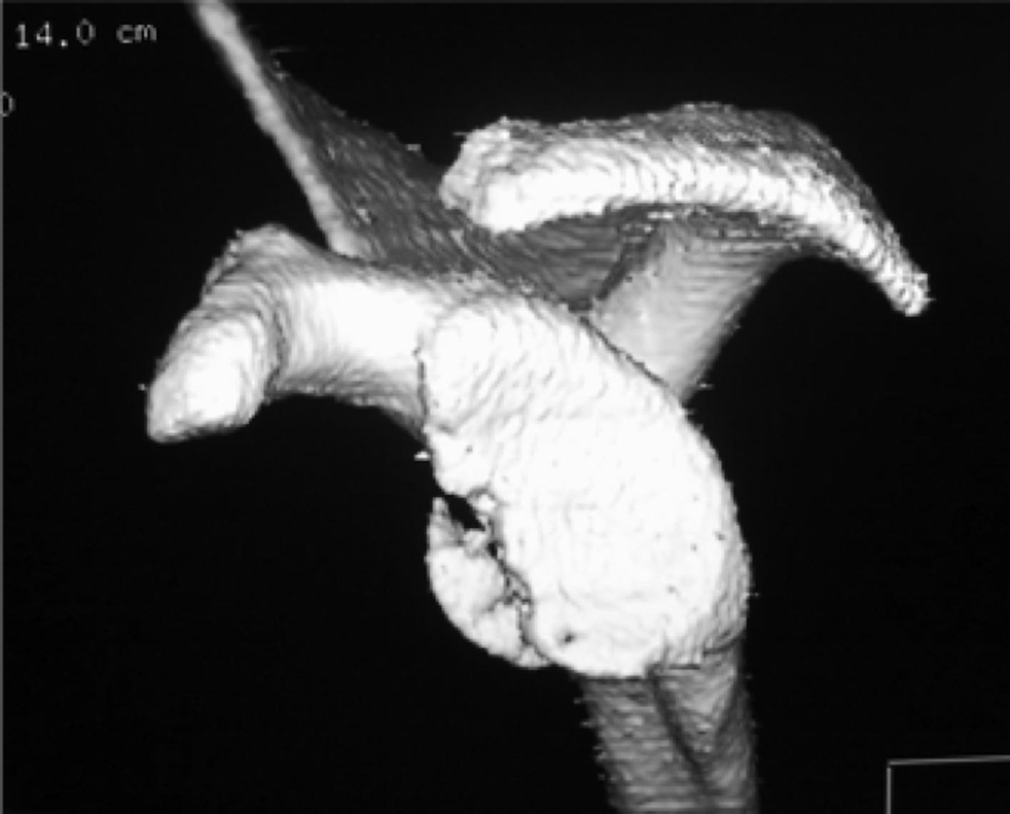 FIG. 8.1, 3-Dimensional (3-D) computed tomography en face view of glenoid bone fragment loss. Image has undergone 3-D digital subtraction of the humeral head.