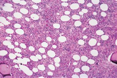 Figure 39.11, Normocellular bone marrow from 42-year-old man obtained as part of evaluation as potential donor for bone marrow transplantation. Hematopoietic cells and adipose tissue are present in approximately equal quantities.