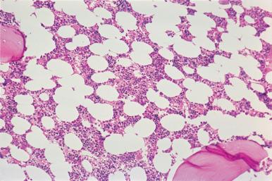 Figure 39.12, Marrow biopsy from a 70-year-old man being evaluated for metastatic tumor. The marrow is approximately 30%–35% cellular, normal for age. There was no evidence of tumor.