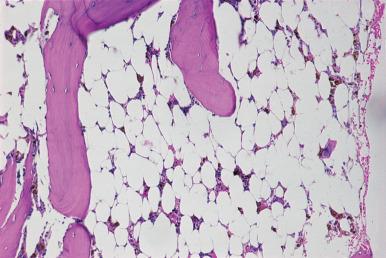 Figure 39.13, Bone Marrow Section From a 7-Year-Old Girl With Idiopathic Acquired Aplastic Anemia.