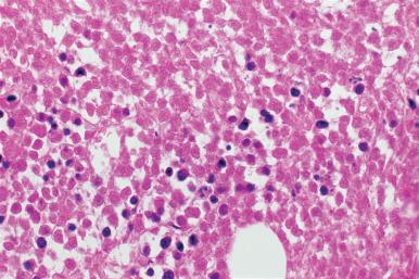 Figure 39.18, Marrow Biopsy From a Patient With Marrow Involvement by Burkitt Lymphoma.