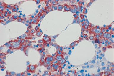 Figure 39.2, Marrow biopsy from patient with multiple myeloma reacted with polyclonal antibody to lambda light chain; the blastic appearing plasma cells show intense cytoplasmic reaction. (Immunoperoxidase.)