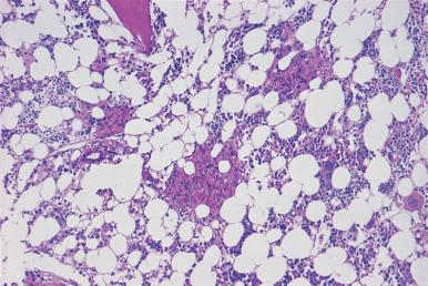 Figure 39.23, Post-Chemotherapy Marrow Biopsy From Patient With Marrow Involvement by Mantle Cell Lymphoma.