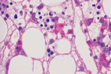 Figure 39.24, Marrow from a patient with AIDS with scattered Pneumocystis jirovecii microorganisms occurring both singly and in small clusters. Microorganisms are not associated with any recognizable tissue response. (Periodic acid–Schiff.)