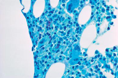 Figure 39.25, Marrow Biopsy From an AIDS Patient.