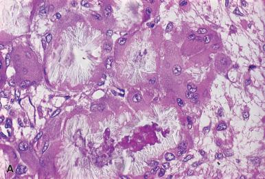 Figure 39.26, A , Section of bone marrow trephine biopsy from a child with primary oxaluria. Calcium oxalate crystals in giant cells form a radial pattern. B , Calcium oxalate crystals are doubly refractile in polarized light.