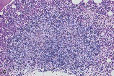 Figure 39.28, A , One of several lymphocytic–histiocytic aggregates in marrow biopsy from a patient with advanced AIDS. Acid-fast bacilli were also identified in this specimen. B , High magnification of specimen in A illustrating polycellular characteristics of the lesion.