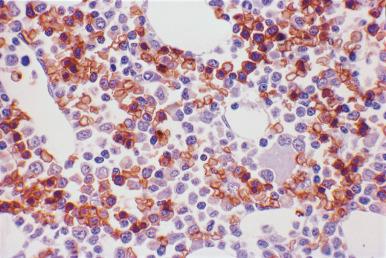 Figure 39.4, Marrow biopsy from a 2-year-old child with congenital neutropenia reacted with antibody to glycophorin A. There are numerous positive erythroid precursors at all stages of maturation. (Immunoperoxidase.)