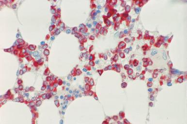 Figure 39.5, Bone marrow biopsy from a patient with hypocellular acute myeloid leukemia reacted with polyclonal antibody to myeloperoxidase. The predominant myeloblasts and promyelocytes show intense cytoplasmic reactivity. (Immunoperoxidase.)