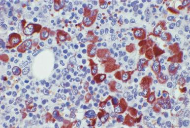 Figure 39.6, Bone marrow biopsy from a patient with chronic myeloid leukemia in accelerated phase reacted with polyclonal antibody to factor VIII–related antigen (von Willebrand factor). There are numerous dysplastic megakaryocytes with hypolobulated nuclei which show intense cytoplasmic reactivity. (Immunoperoxidase.)