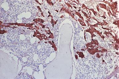 Figure 39.10, Marrow biopsy from a child with neuroblastoma with ganglion differentiation reacted with antibody to neuron-specific enolase. The tumor cells are intensely reactive. (Immunoperoxidase.)