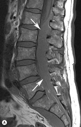 Fig. 65.3, Chronic Lymphatic Leukaemia.