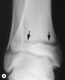 Fig. 65.4, Leukaemia.