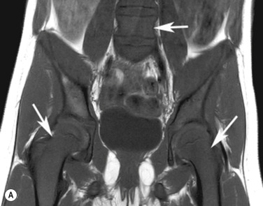 Fig. 65.5, Leukaemia.