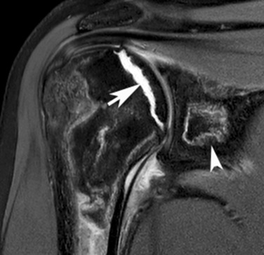 Fig. 65.6, Leukaemia.