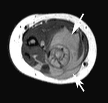 Fig. 65.7, Myeloid Sarcoma.