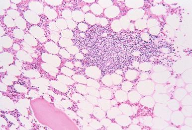 Figure 56-2, Benign lymphoid aggregate in a bone marrow core biopsy.