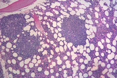 Figure 56-12, Chronic lymphocytic leukemia/small lymphocytic lymphoma in the bone marrow core biopsy.