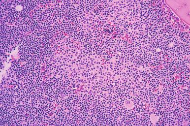 Figure 56-13, Proliferation centers of chronic lymphocytic leukemia/small lymphocytic lymphoma in a bone marrow core biopsy.