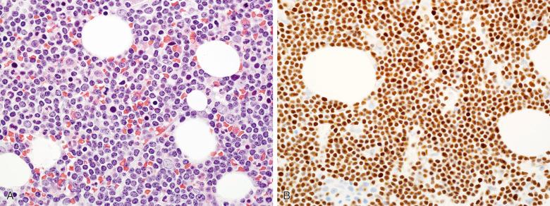 Figure 56-14, Chronic lymphocytic leukemia/small lymphocytic lymphoma (CLL/SLL) is positive for LEF1.