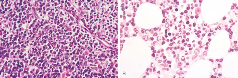 Figure 56-15, Lymphoplasmacytic lymphoma in a bone marrow core biopsy.